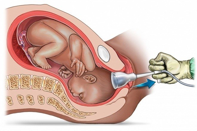 Rách tầng sinh môn do can thiệp sản khoa đường dưới